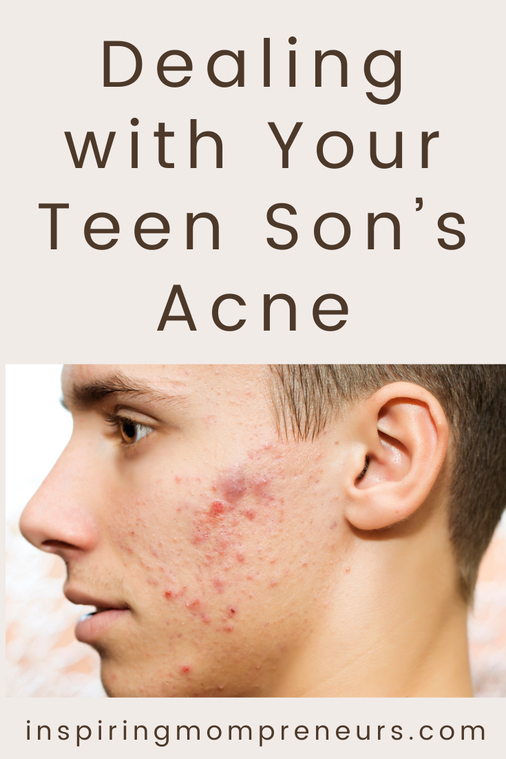 Dealing with Your Teen Son’s Acne | Teen Boy Acne pin