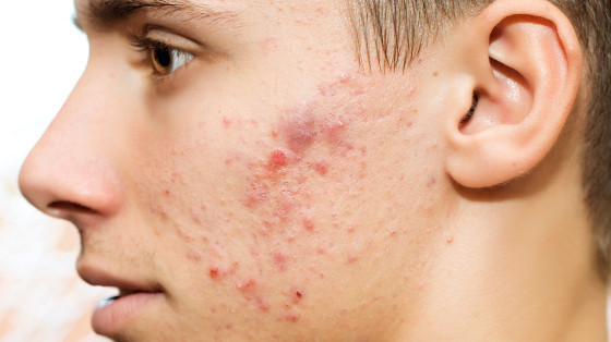Dealing with Your Teen Son's Acne