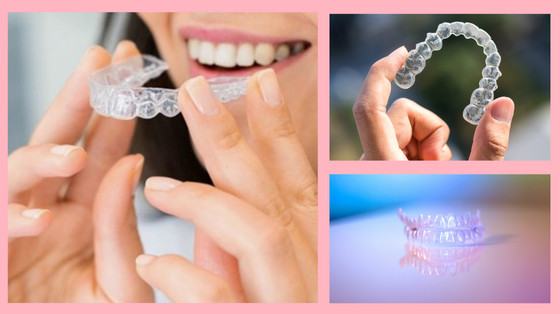 FAQs about invisible aligners