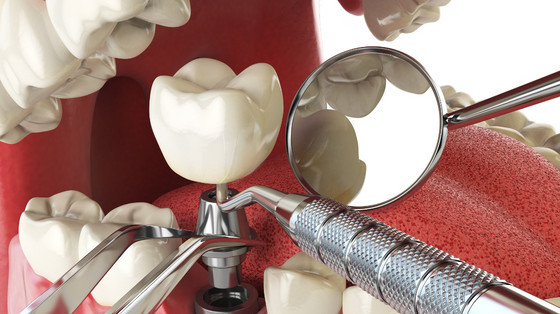 Rebuild A Full Set of Teeth with Dental Implants