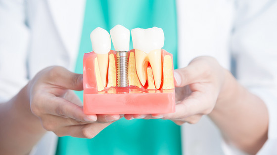 what are dental implants